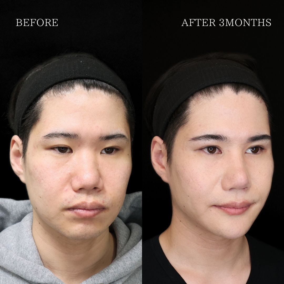 目頭切開術/眼瞼下垂（目つき矯正）の症例写真 施術前後 