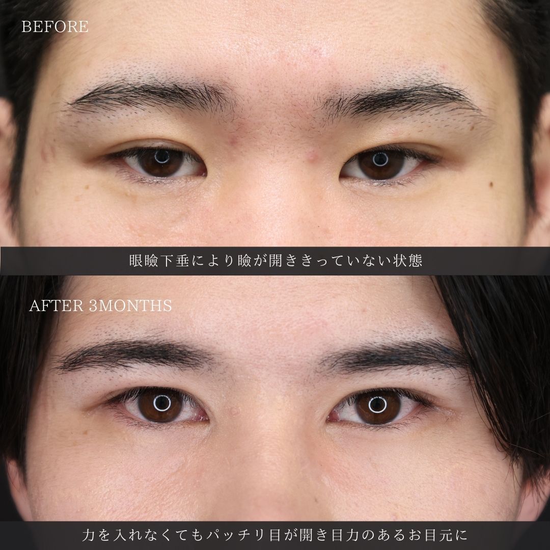 目頭切開術/眼瞼下垂（目つき矯正）の症例写真 施術前後 
