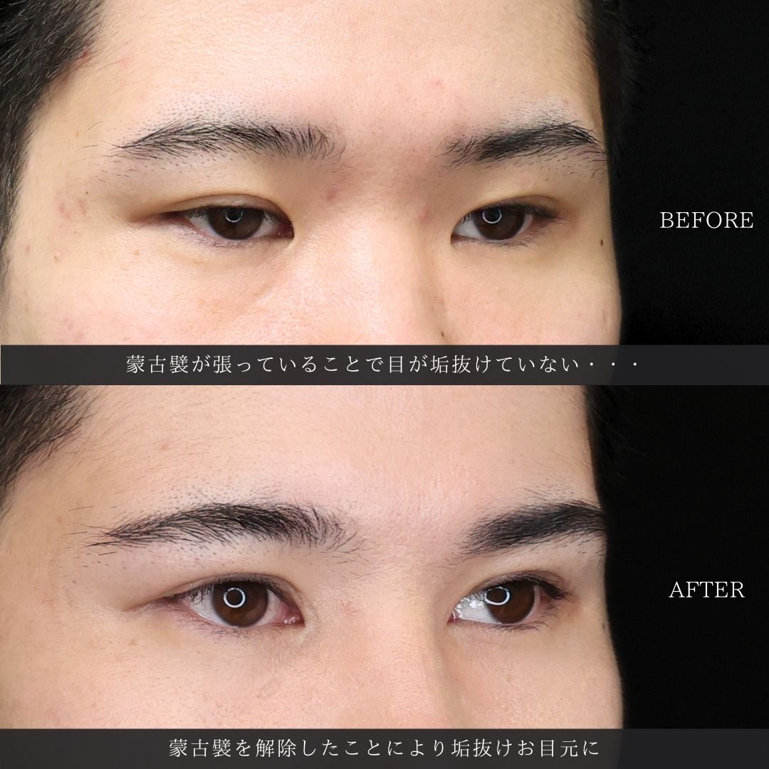 目頭切開術/眼瞼下垂（目つき矯正）の症例写真 施術前後 
