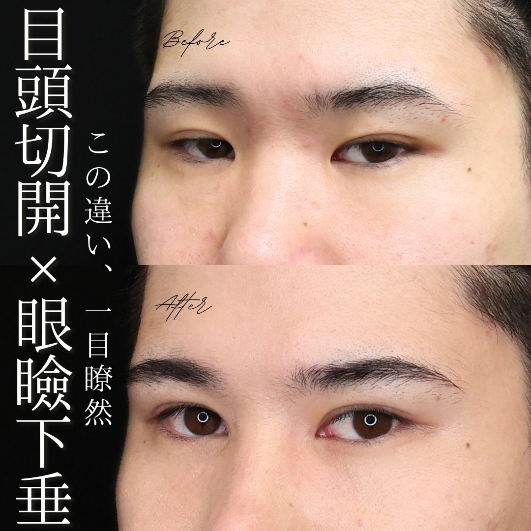目頭切開術/眼瞼下垂（目つき矯正）の症例写真 施術前後 