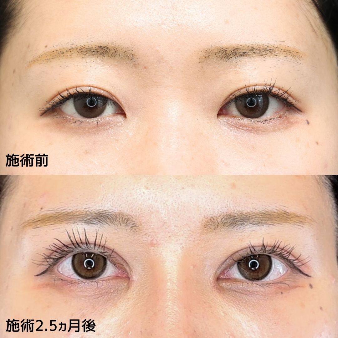 《形成外科医専門医による目元切開術》眠そうな目元から目力アップへ