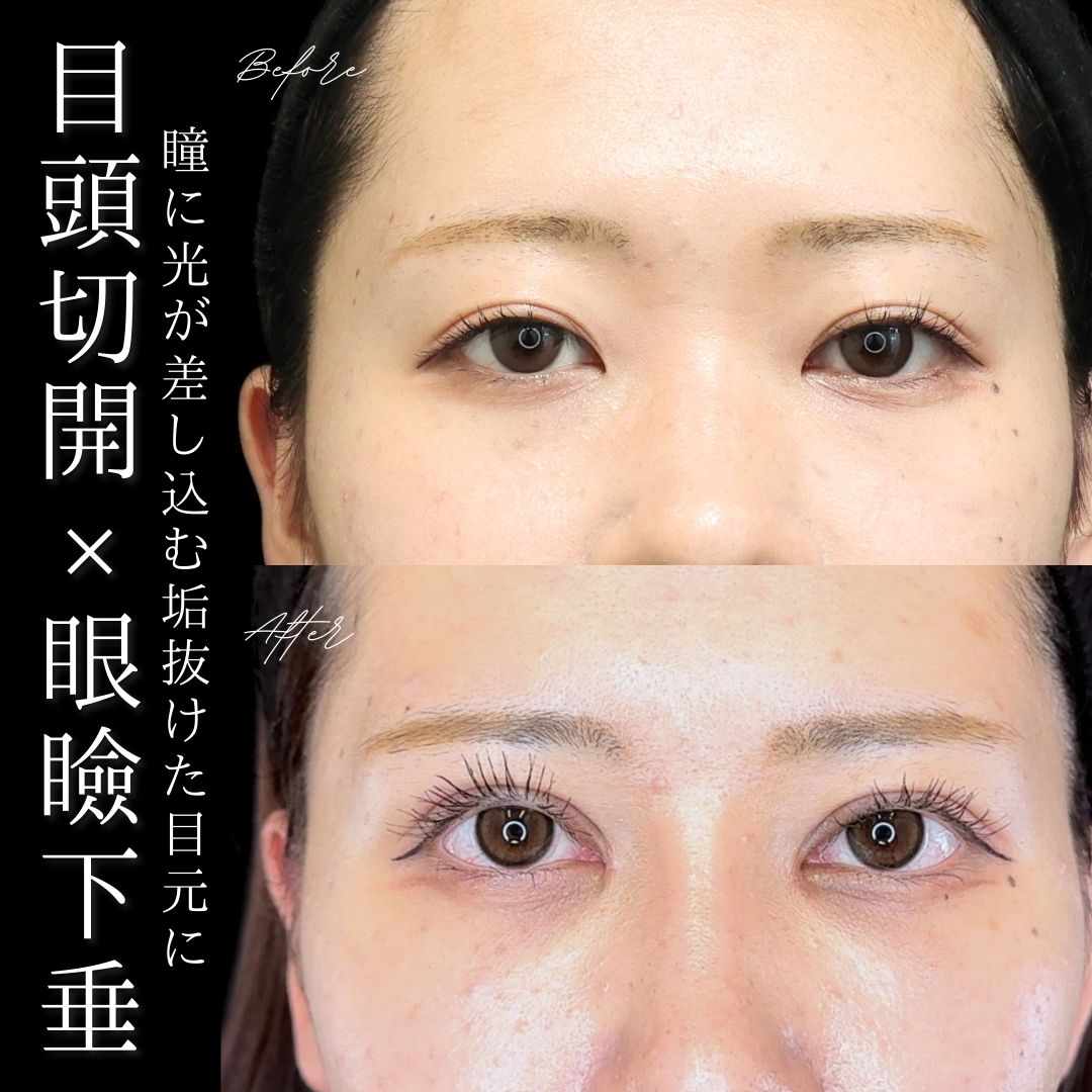 眼瞼下垂（目つき矯正）/上眼瞼切開術/目頭切開術の症例写真 施術前後 
