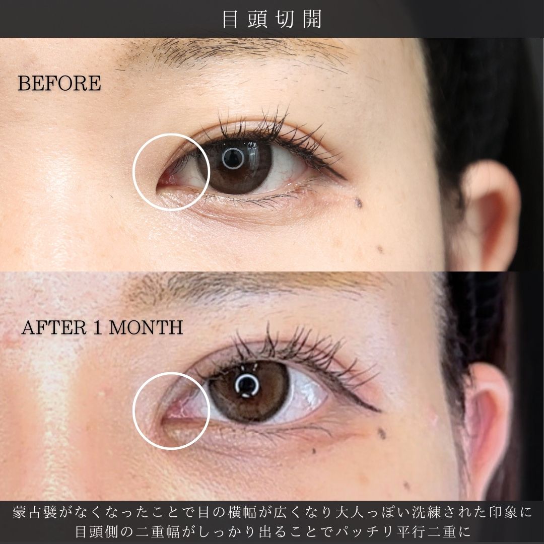眼瞼下垂（目つき矯正）/上眼瞼切開術/目頭切開術の症例写真 施術前後 