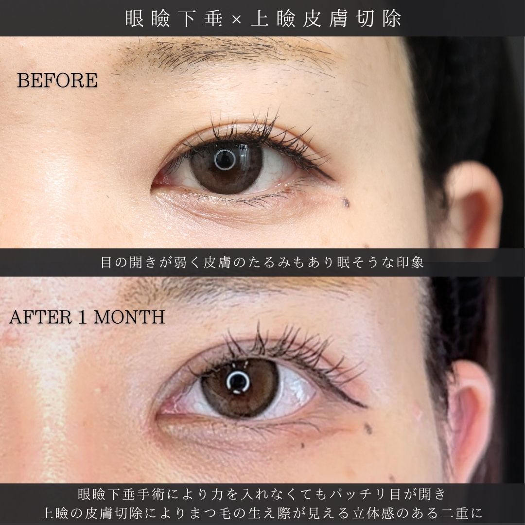 眼瞼下垂（目つき矯正）/上眼瞼切開術/目頭切開術の症例写真 施術前後 