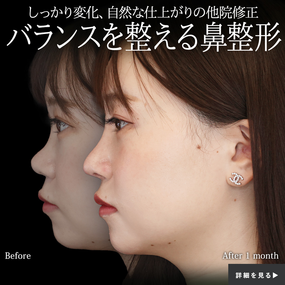 隆鼻術(プロテーゼ・自家組織)/鼻尖形成・鼻尖縮小/鼻中隔延長術の症例写真 施術前後