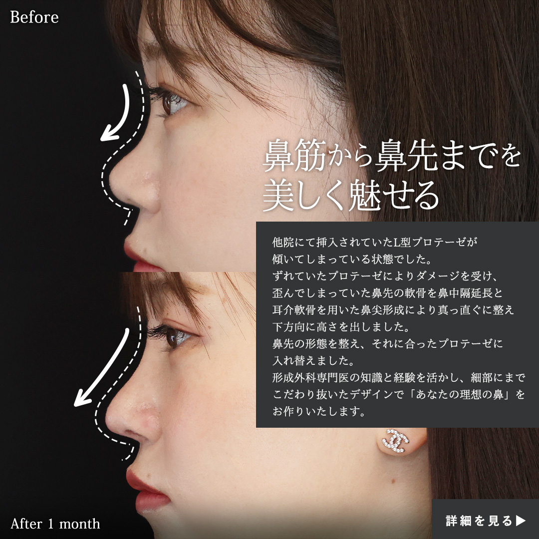 隆鼻術(プロテーゼ・自家組織)/鼻尖形成・鼻尖縮小/鼻中隔延長術の症例写真 施術前後
