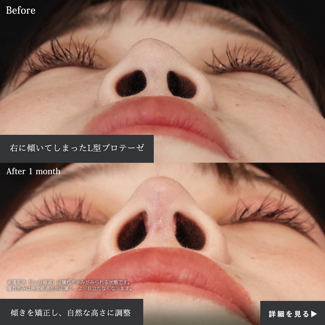 隆鼻術(プロテーゼ・自家組織)/鼻尖形成・鼻尖縮小/鼻中隔延長術の症例写真 施術前後
