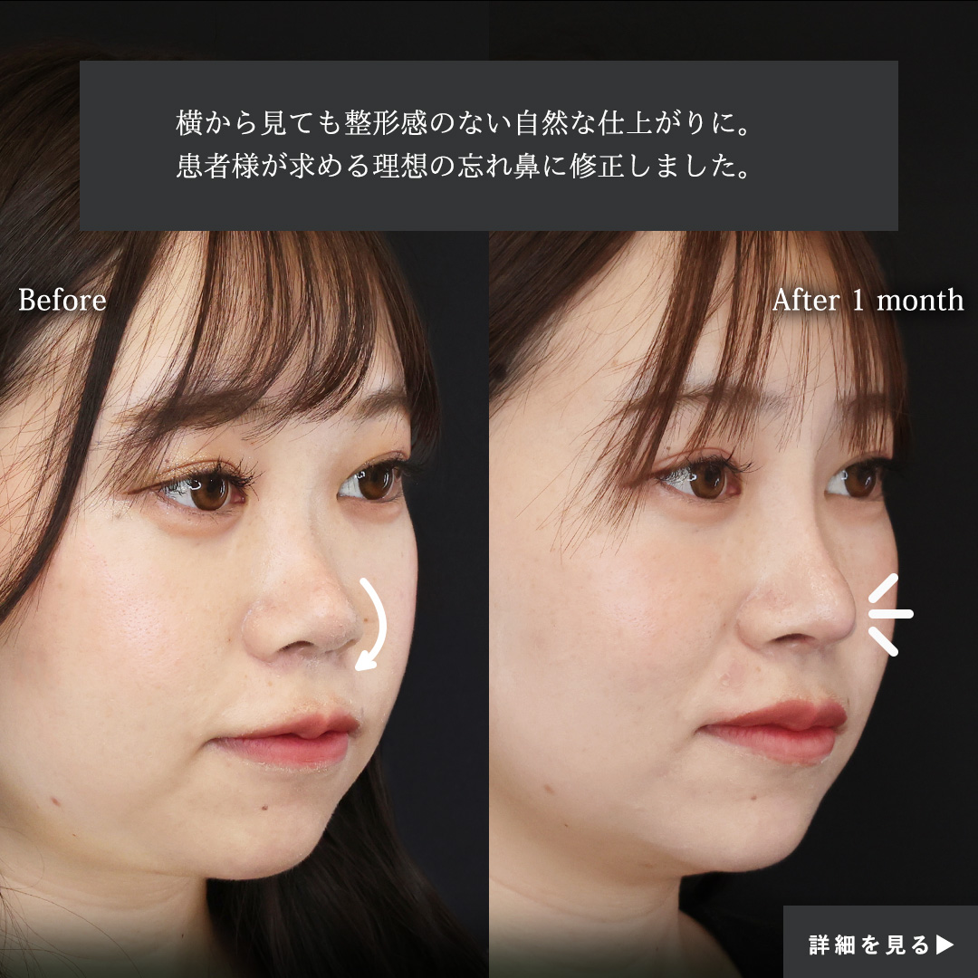 隆鼻術(プロテーゼ・自家組織)/鼻尖形成・鼻尖縮小/鼻中隔延長術の症例写真 施術前後