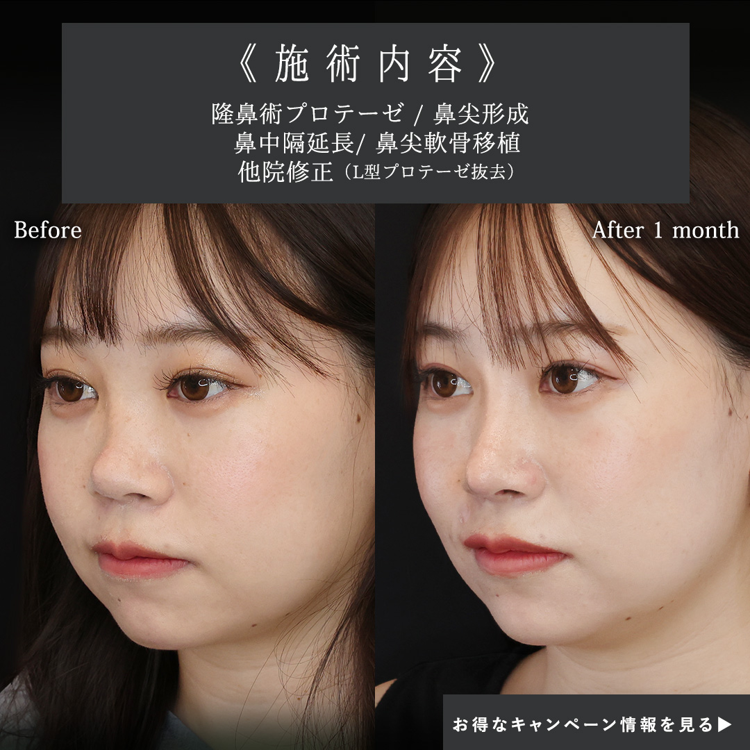 隆鼻術(プロテーゼ・自家組織)/鼻尖形成・鼻尖縮小/鼻中隔延長術の症例写真 施術前後