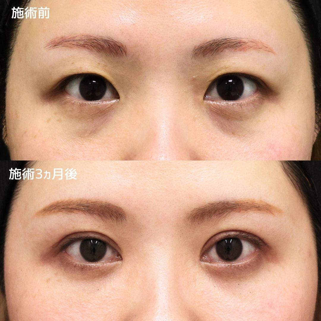 《目元切開》まつ毛の生え際が見える平行二重に