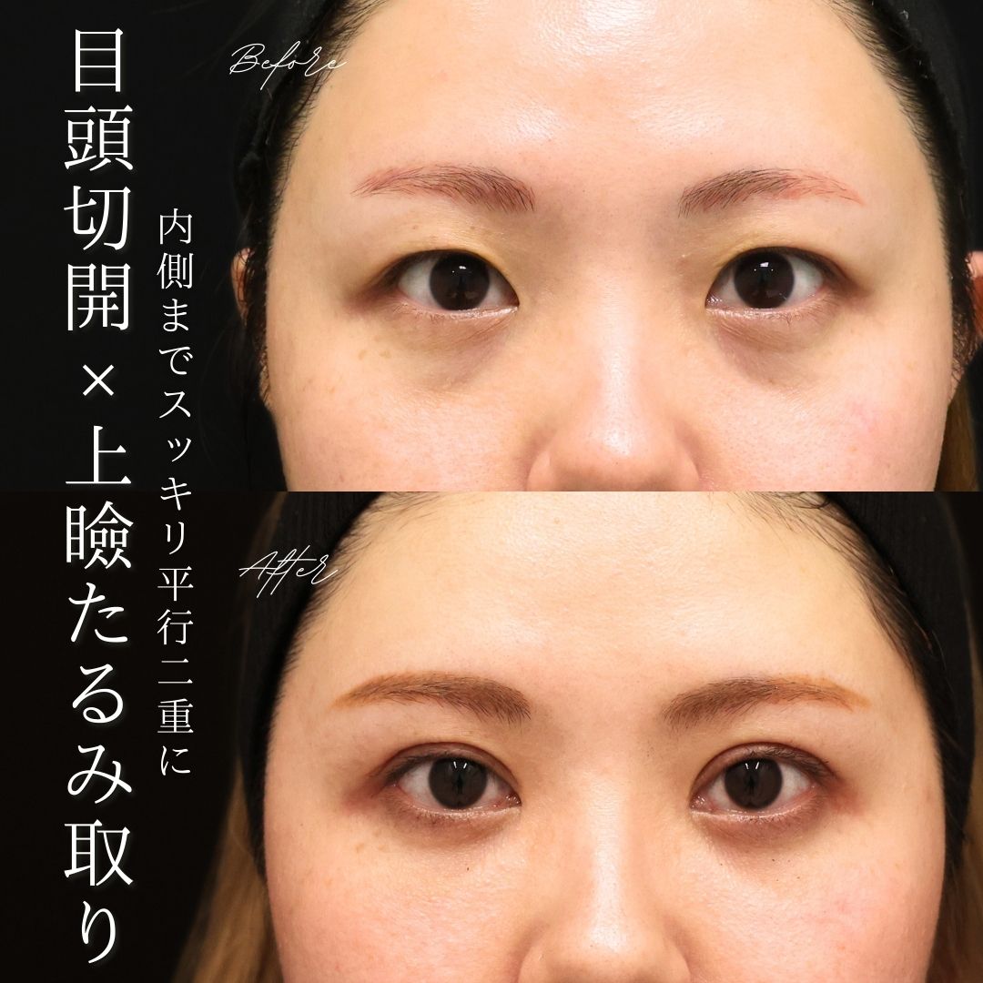 上眼瞼切開術/目頭切開術の症例写真 施術前後 