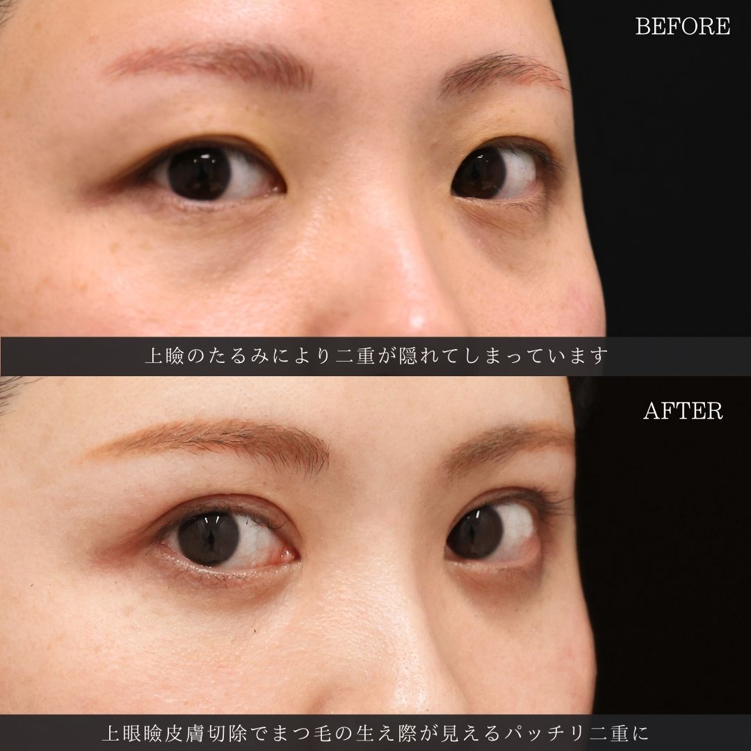 上眼瞼切開術/目頭切開術の症例写真 施術前後 