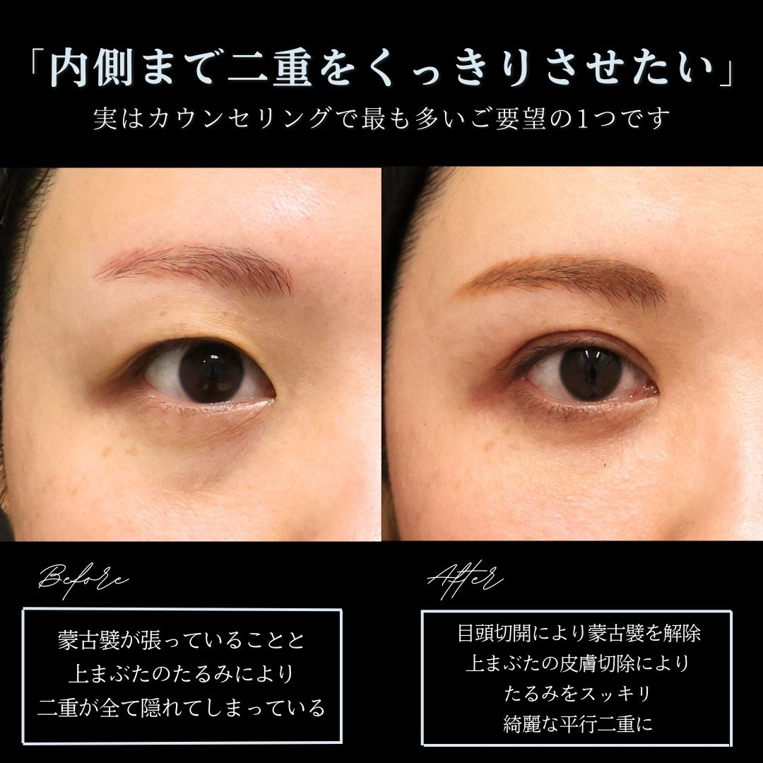 上眼瞼切開術/目頭切開術の症例写真 施術前後 