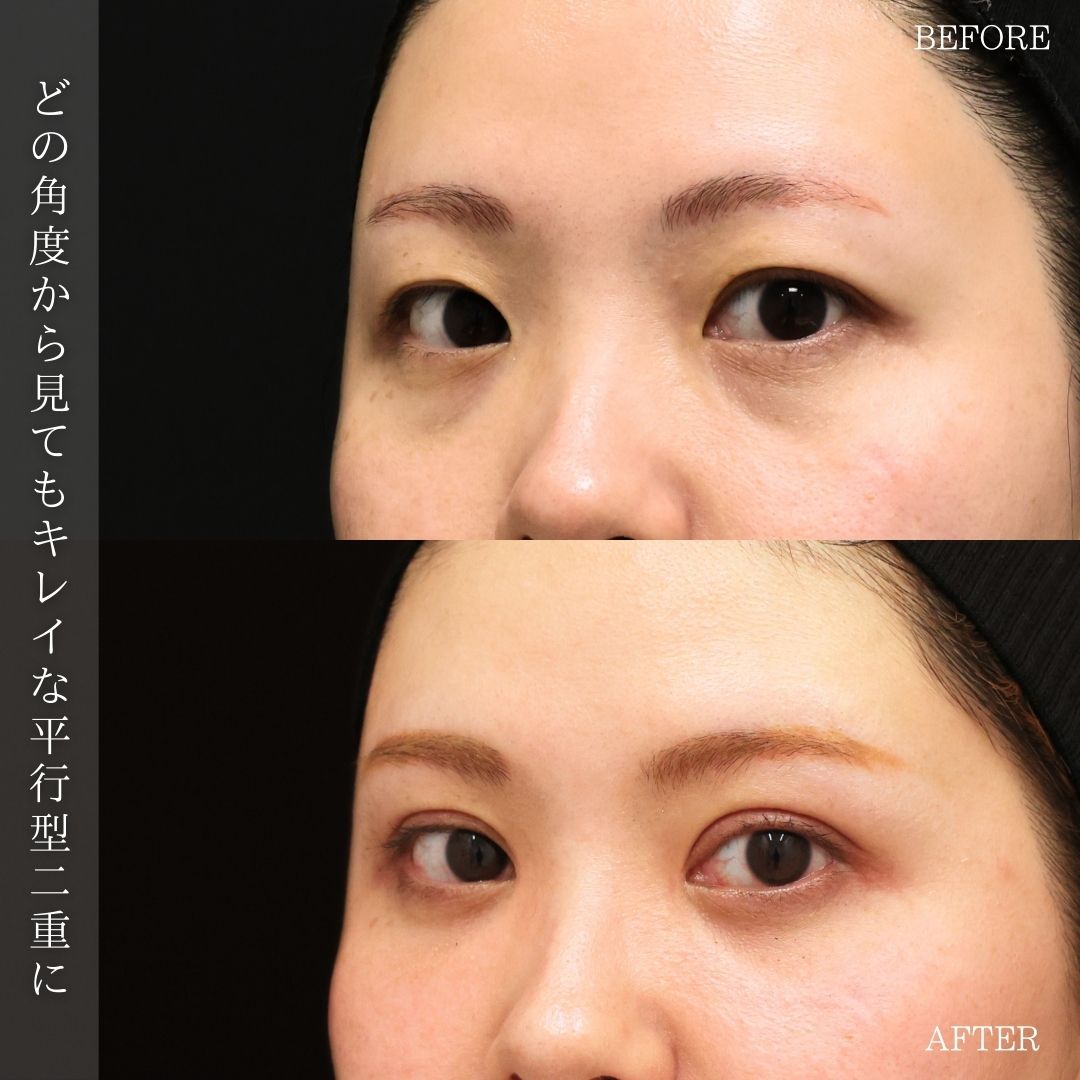 上眼瞼切開術/目頭切開術の症例写真 施術前後 