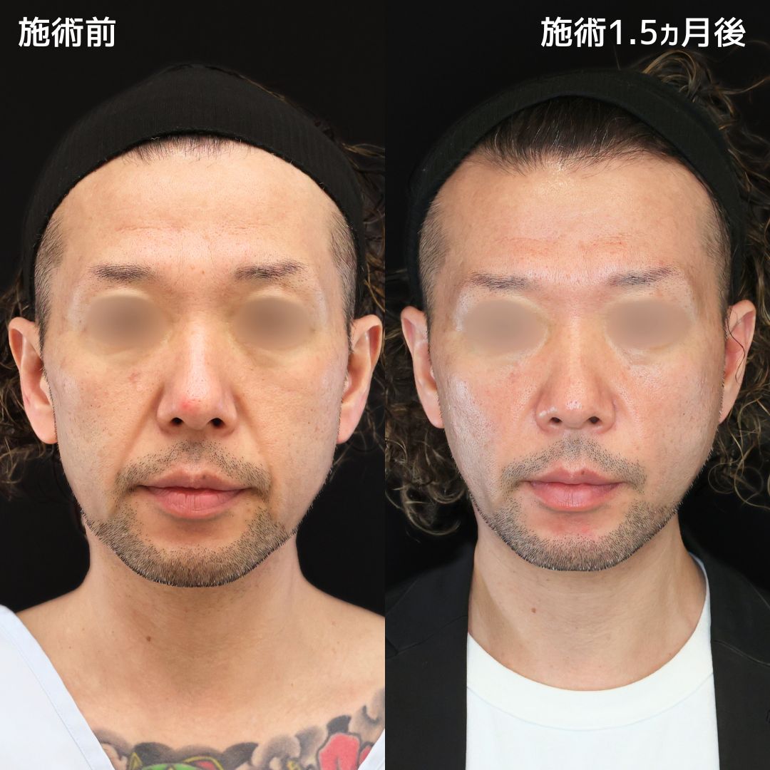 《ほうれい線を改善したい方必見》ナゾラビアルファット除去術