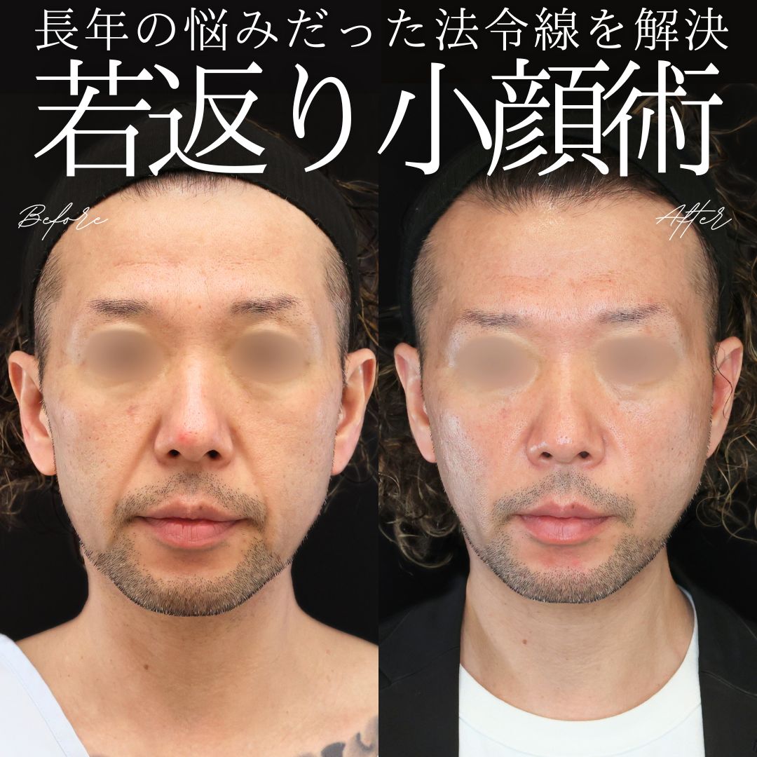 ナゾラビアルファット除去/ほうれい線のヒアルロン酸注射/TAC式 ツヤ肌コラーゲンリフト®の症例写真 施術前後 