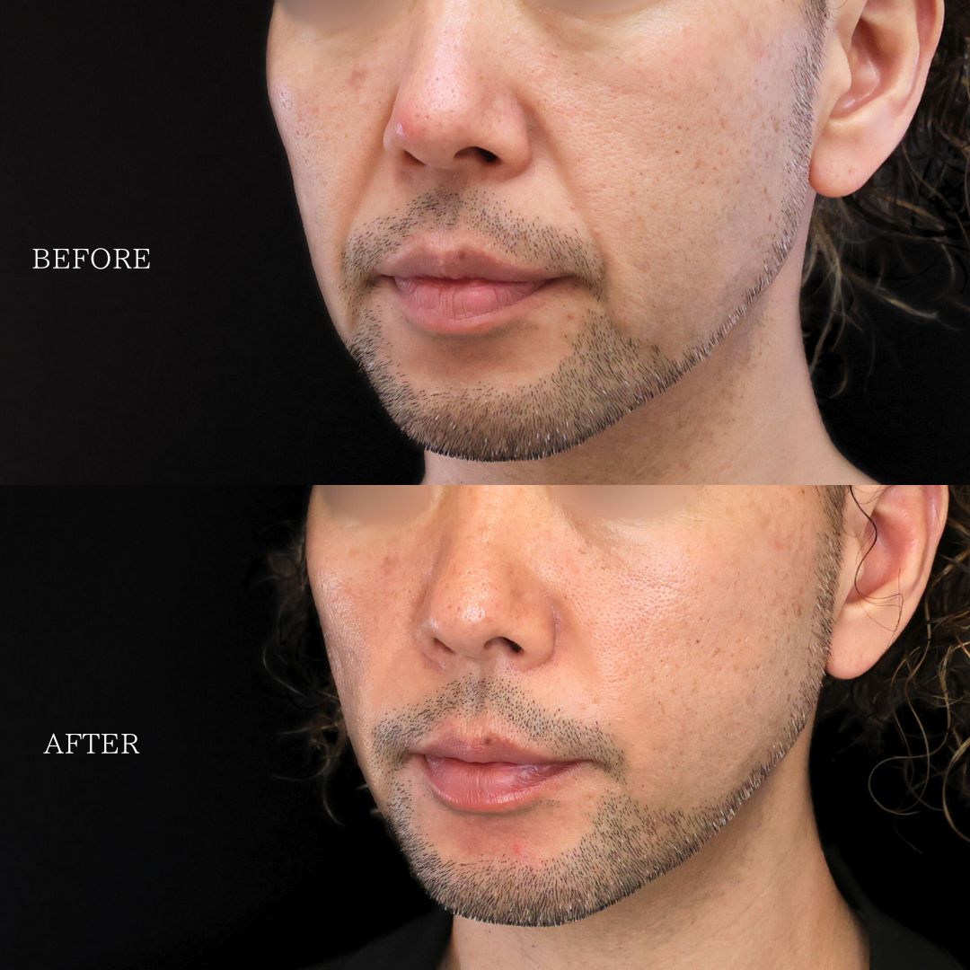 ナゾラビアルファット除去/ほうれい線のヒアルロン酸注射/TAC式 ツヤ肌コラーゲンリフト®の症例写真 施術前後 