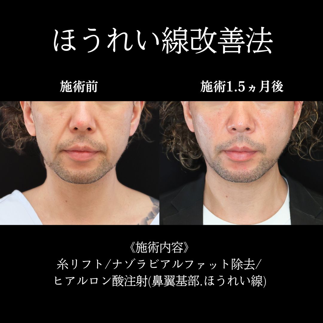 ナゾラビアルファット除去/ほうれい線のヒアルロン酸注射/TAC式 ツヤ肌コラーゲンリフト®の症例写真 施術前後 