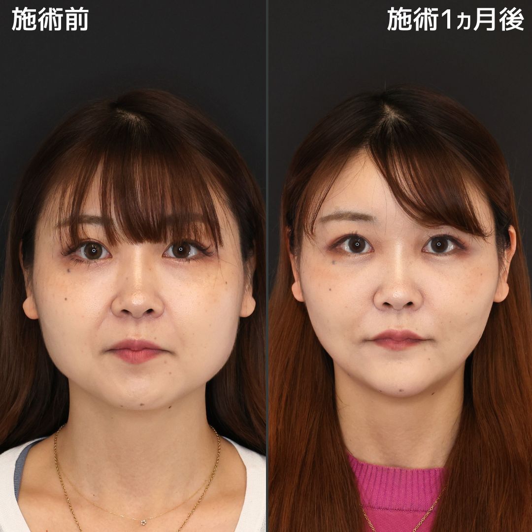 《小顔整形》周りの人たちからたくさん褒めてもらえました