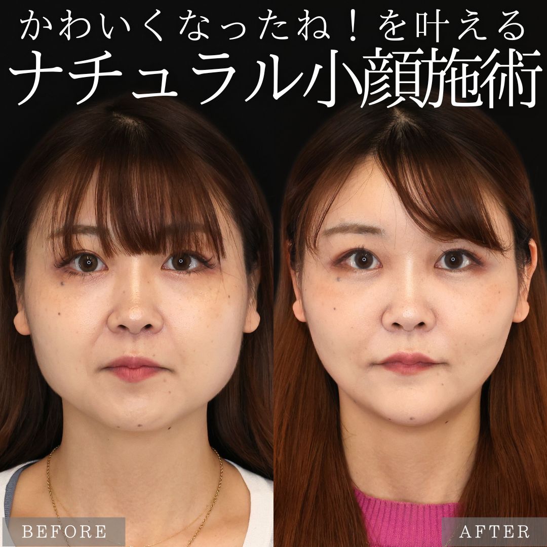 バッカルファット除去/ジョールファット除去/顔の脂肪吸引の症例写真 施術前後 