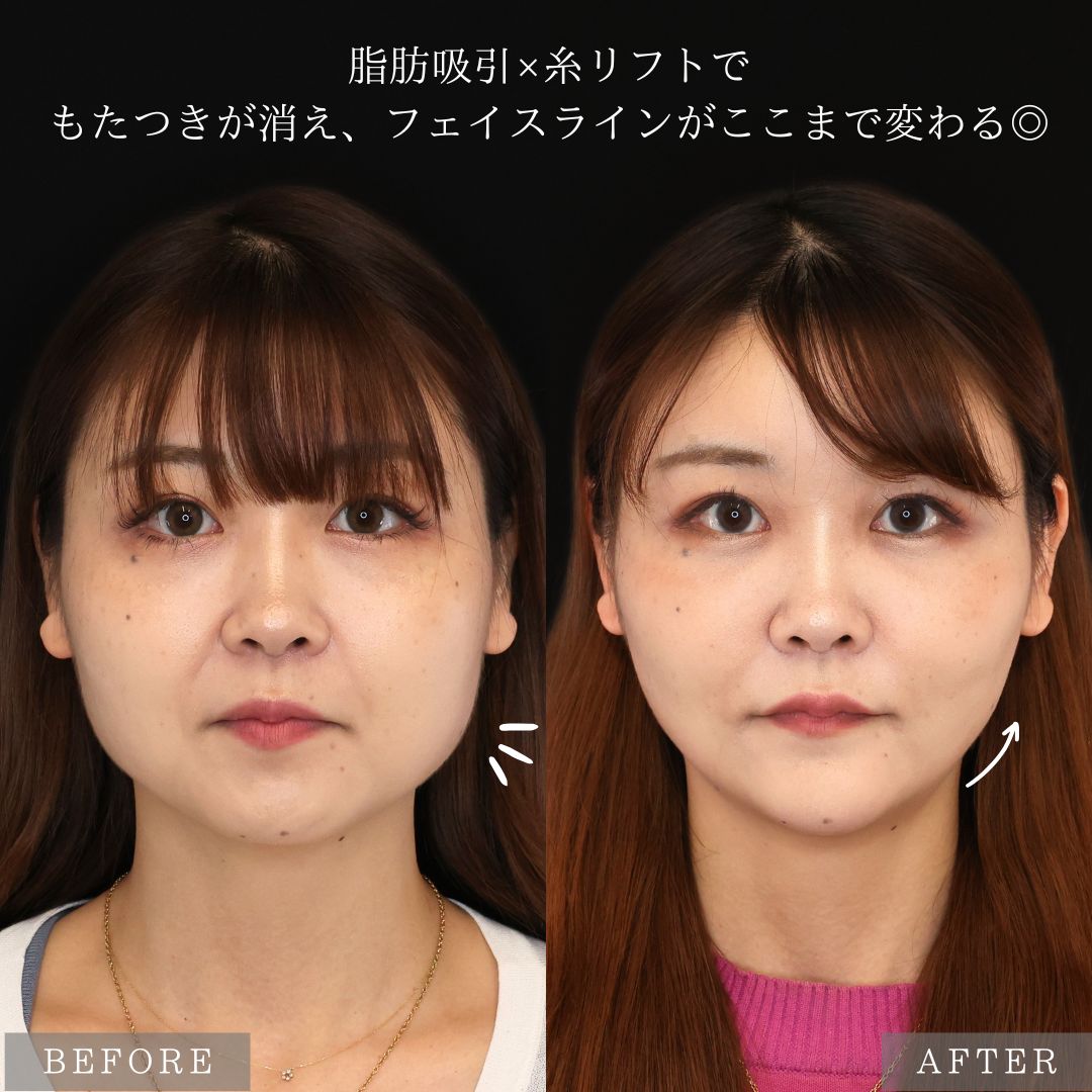 バッカルファット除去/ジョールファット除去/顔の脂肪吸引の症例写真 施術前後 
