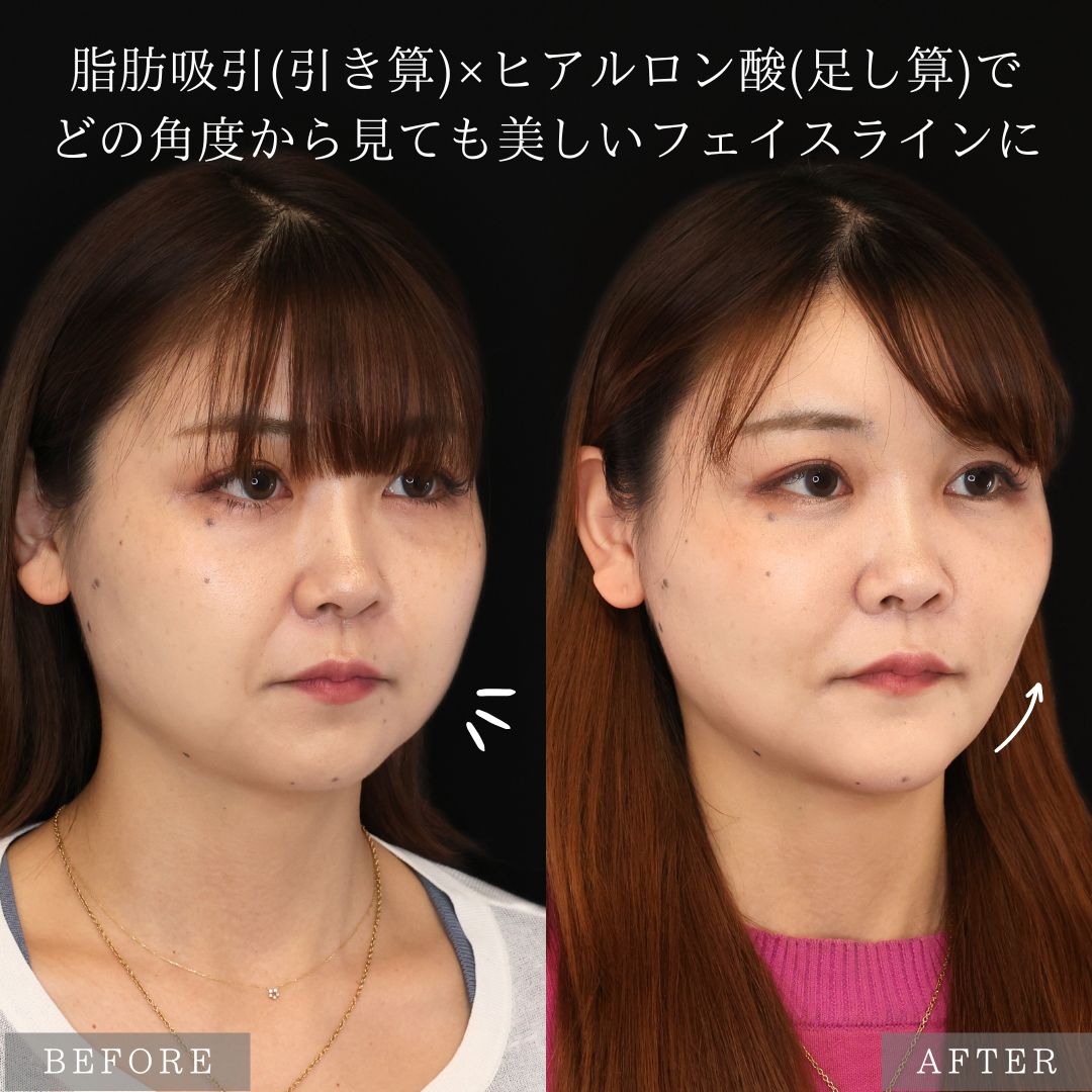 バッカルファット除去/ジョールファット除去/顔の脂肪吸引の症例写真 施術前後 