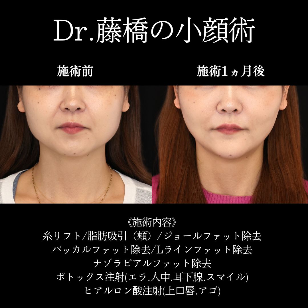 バッカルファット除去/ジョールファット除去/顔の脂肪吸引の症例写真 施術前後 