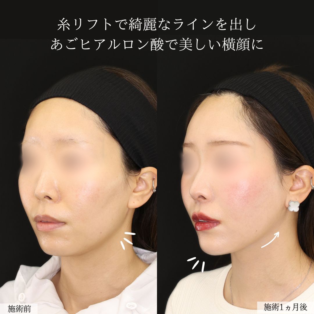 TAC式 ツヤ肌コラーゲンリフト®/エラボトックス注射/顎のヒアルロン酸注射の症例写真 施術前後 