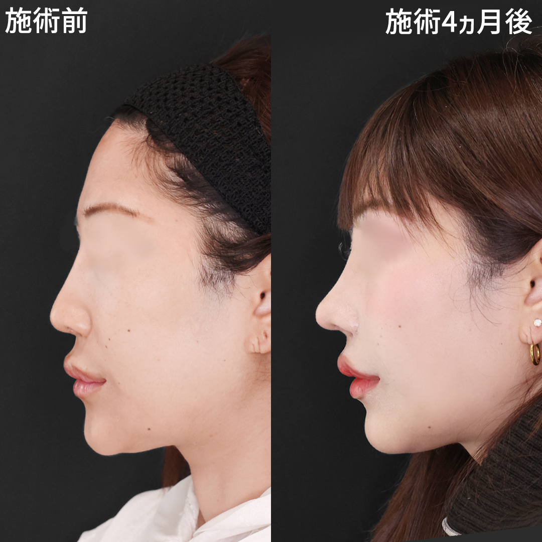 傷跡 修正術の症例写真・画像・ビフォーアフター｜美容整形