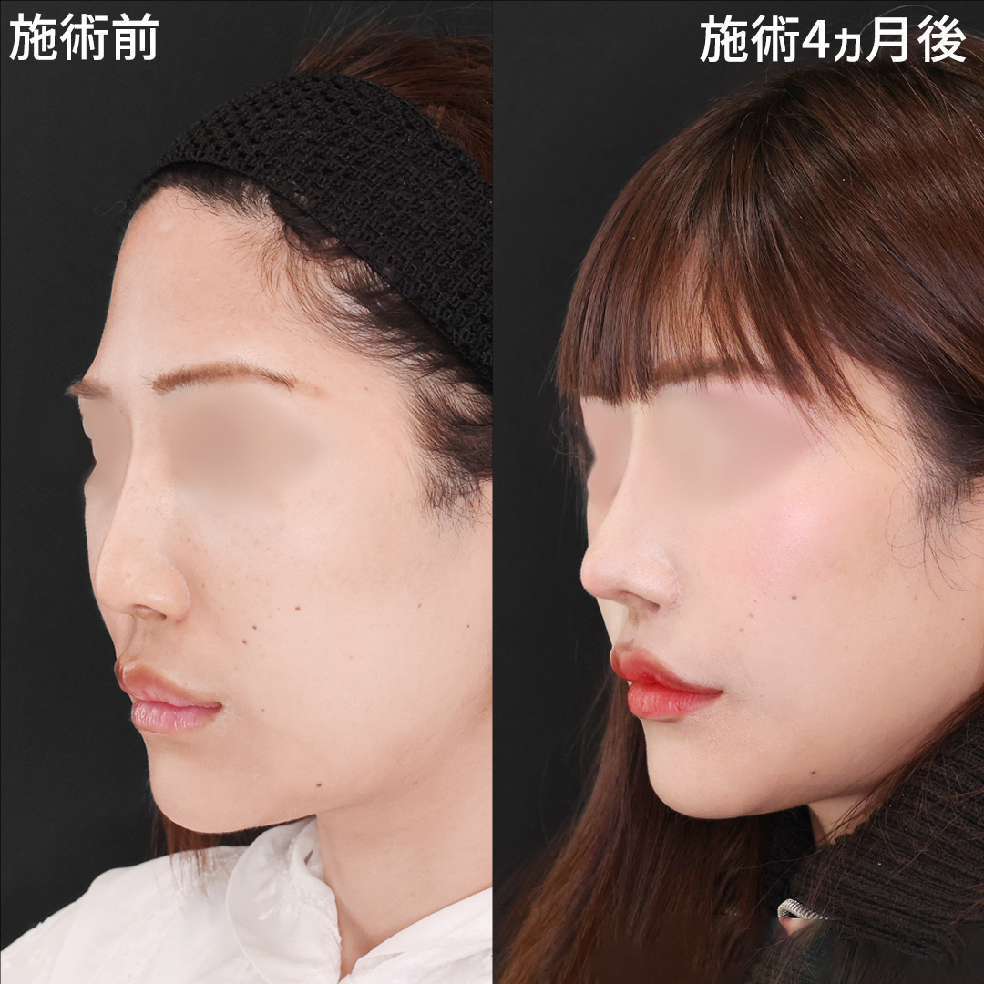 鼻中隔延長術/鼻尖形成・鼻尖縮小/M字リップ形成術の症例写真 施術前後 