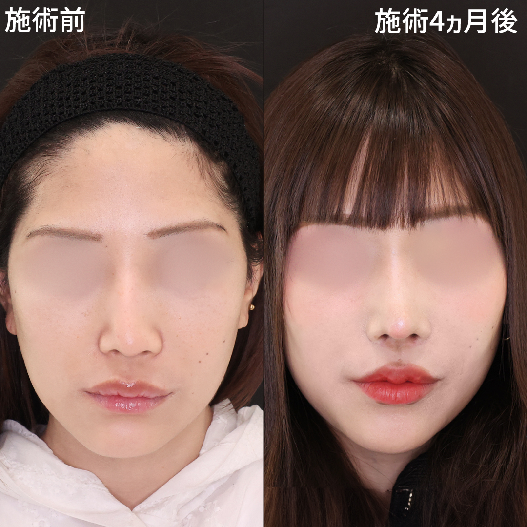 鼻中隔延長術/鼻尖形成・鼻尖縮小/M字リップ形成術の症例写真 施術前後 
