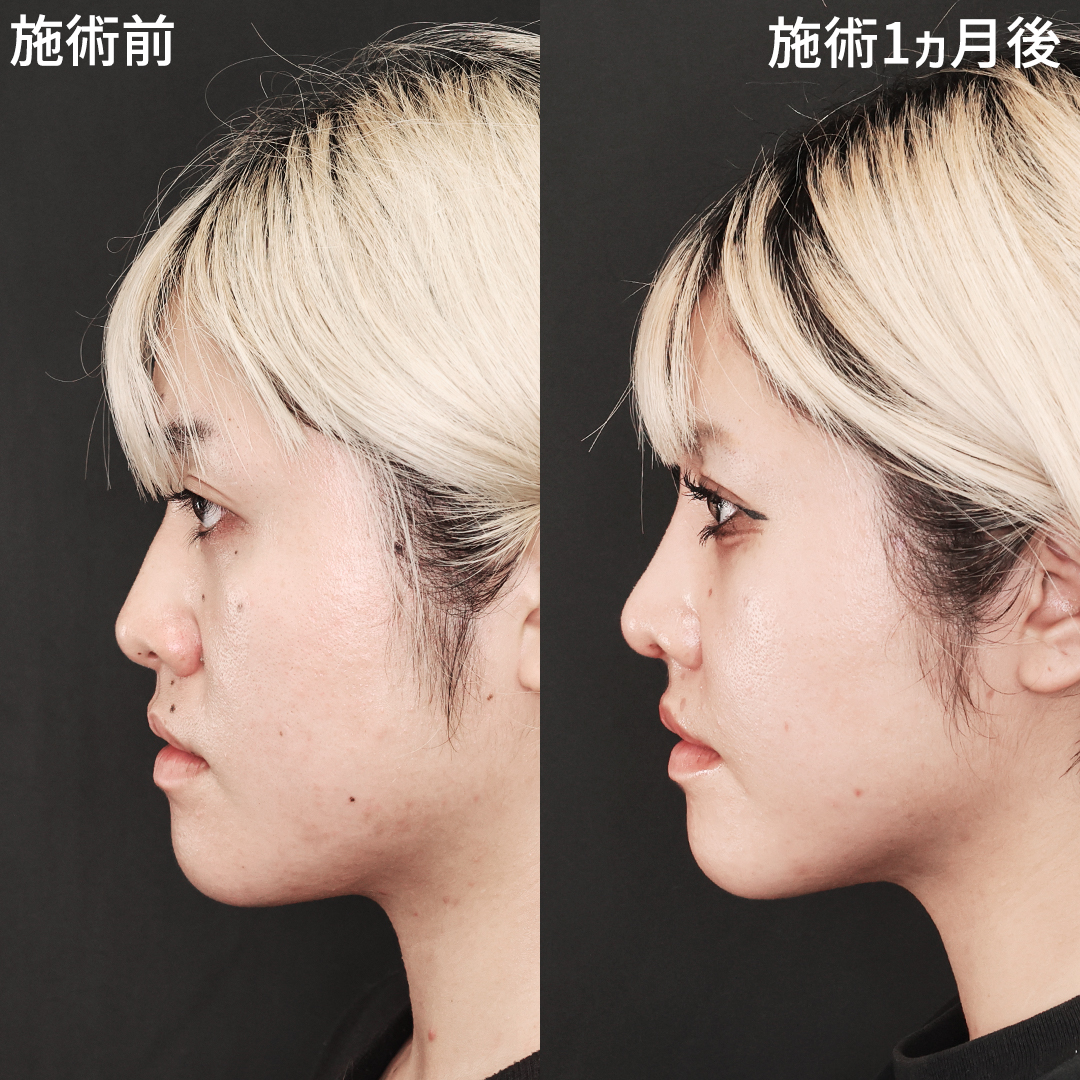 鼻尖形成・鼻尖縮小/TAC式 鼻翼縮小術(小鼻縮小)/ホクロ除去の症例写真 施術前後