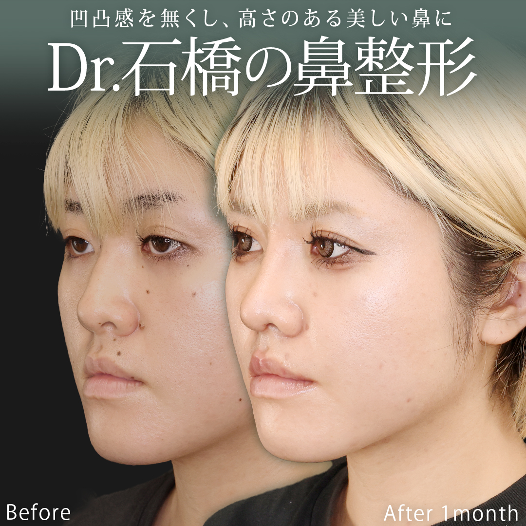 鼻尖形成・鼻尖縮小/TAC式 鼻翼縮小術(小鼻縮小)/ホクロ除去の症例写真 施術前後