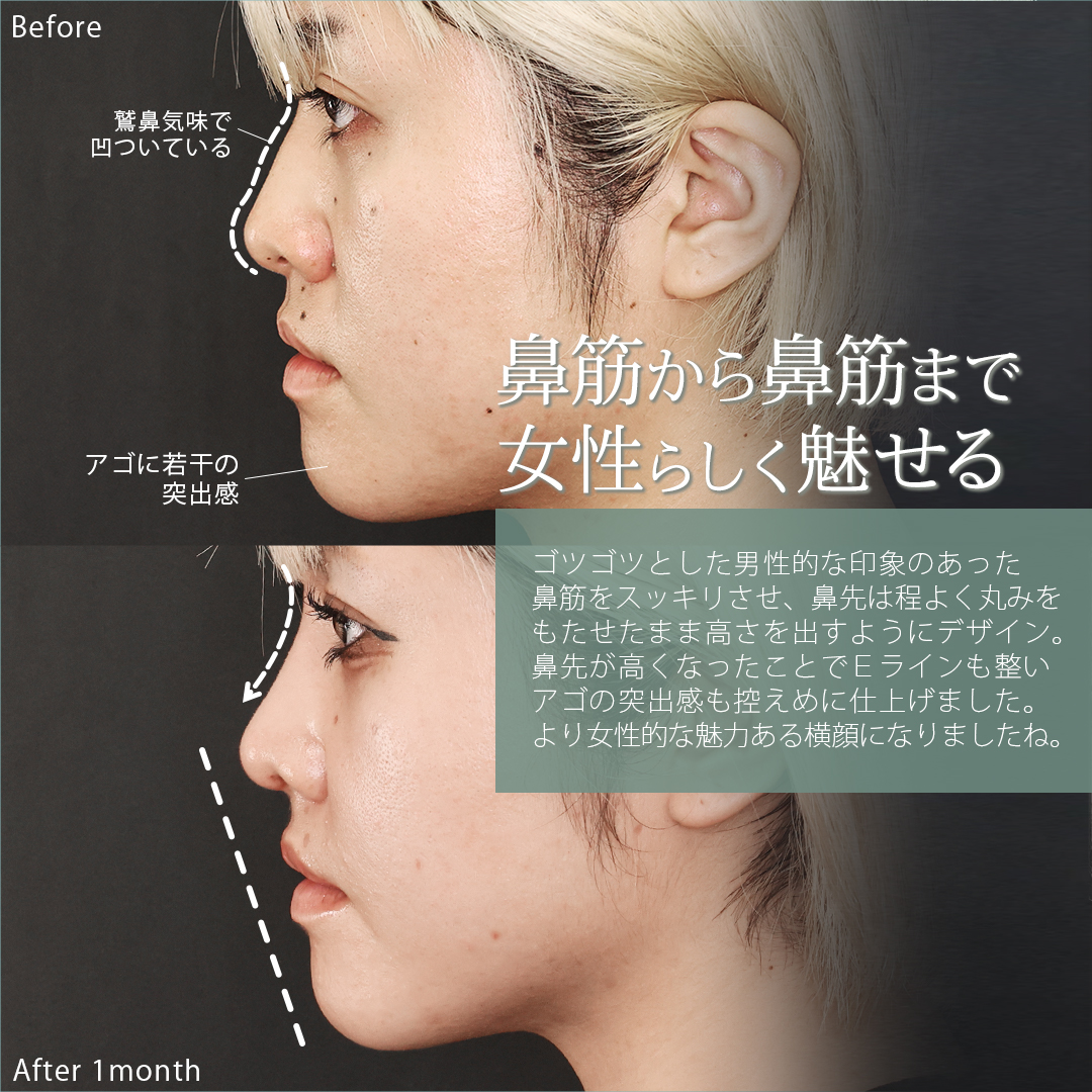 鼻尖形成・鼻尖縮小/TAC式 鼻翼縮小術(小鼻縮小)/ホクロ除去の症例写真 施術前後