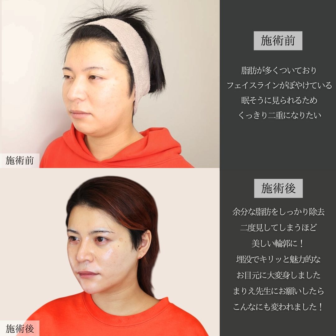 二重埋没法/バッカルファット除去/ジョールファット除去の症例写真 施術前後 