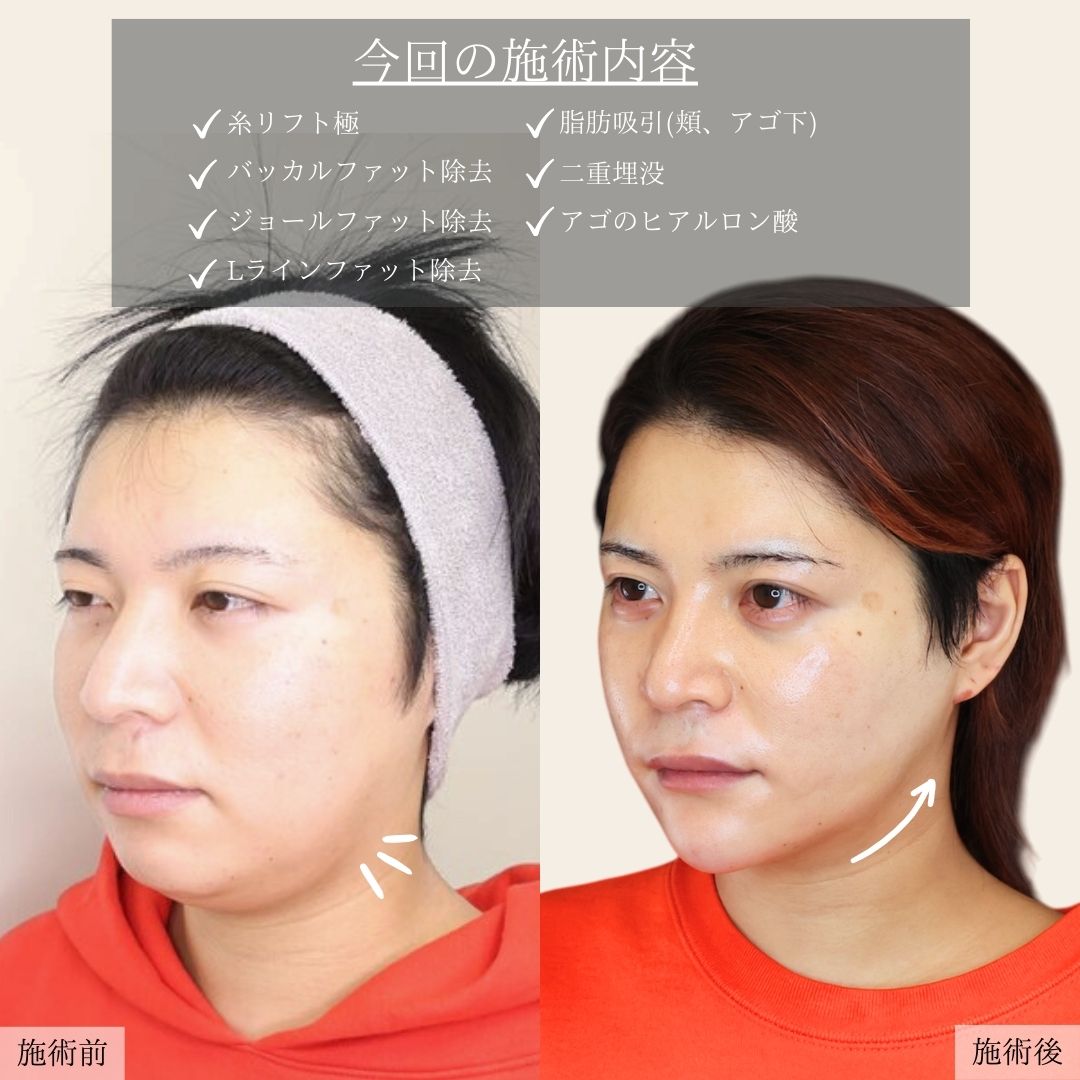 二重埋没法/バッカルファット除去/ジョールファット除去の症例写真 施術前後 