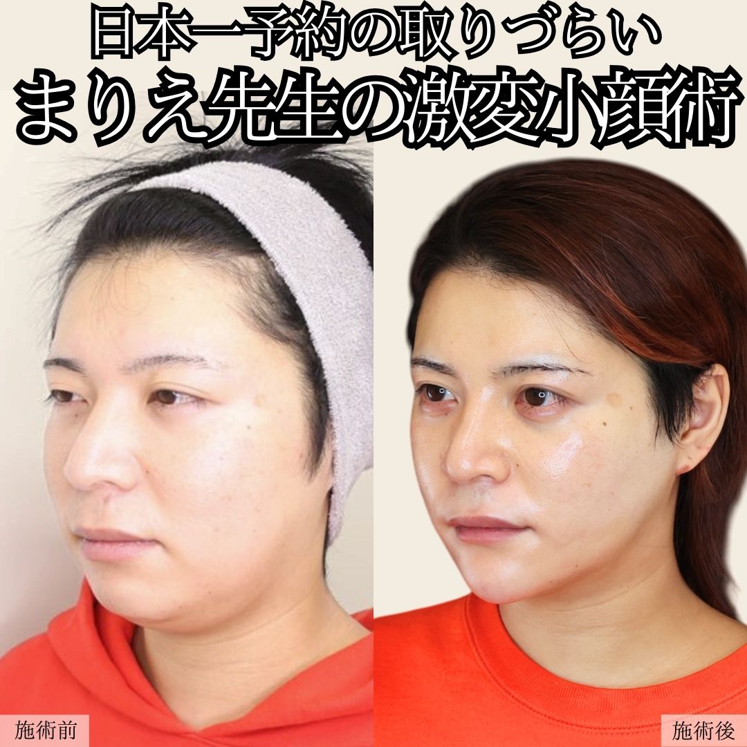 二重埋没法/バッカルファット除去/ジョールファット除去の症例写真 施術前後 