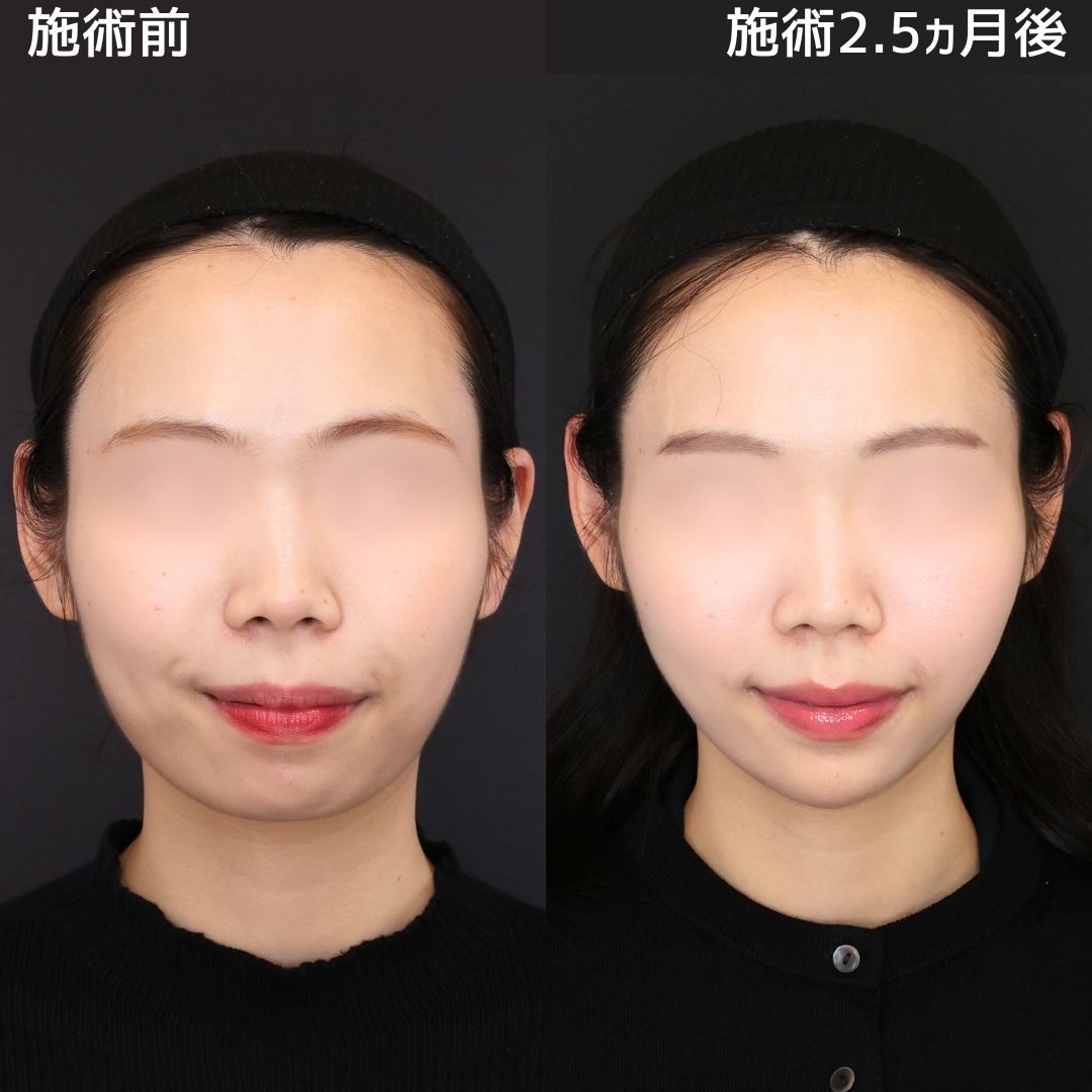 《小顔整形》理想の輪郭なりました