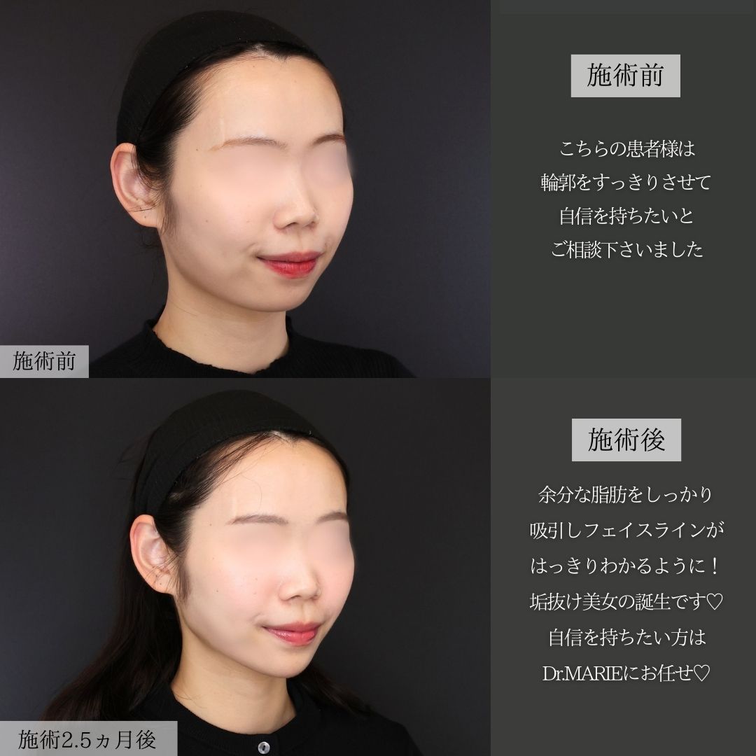 エラボトックス注射/顔の脂肪吸引/ジョールファット除去の症例写真 施術前後