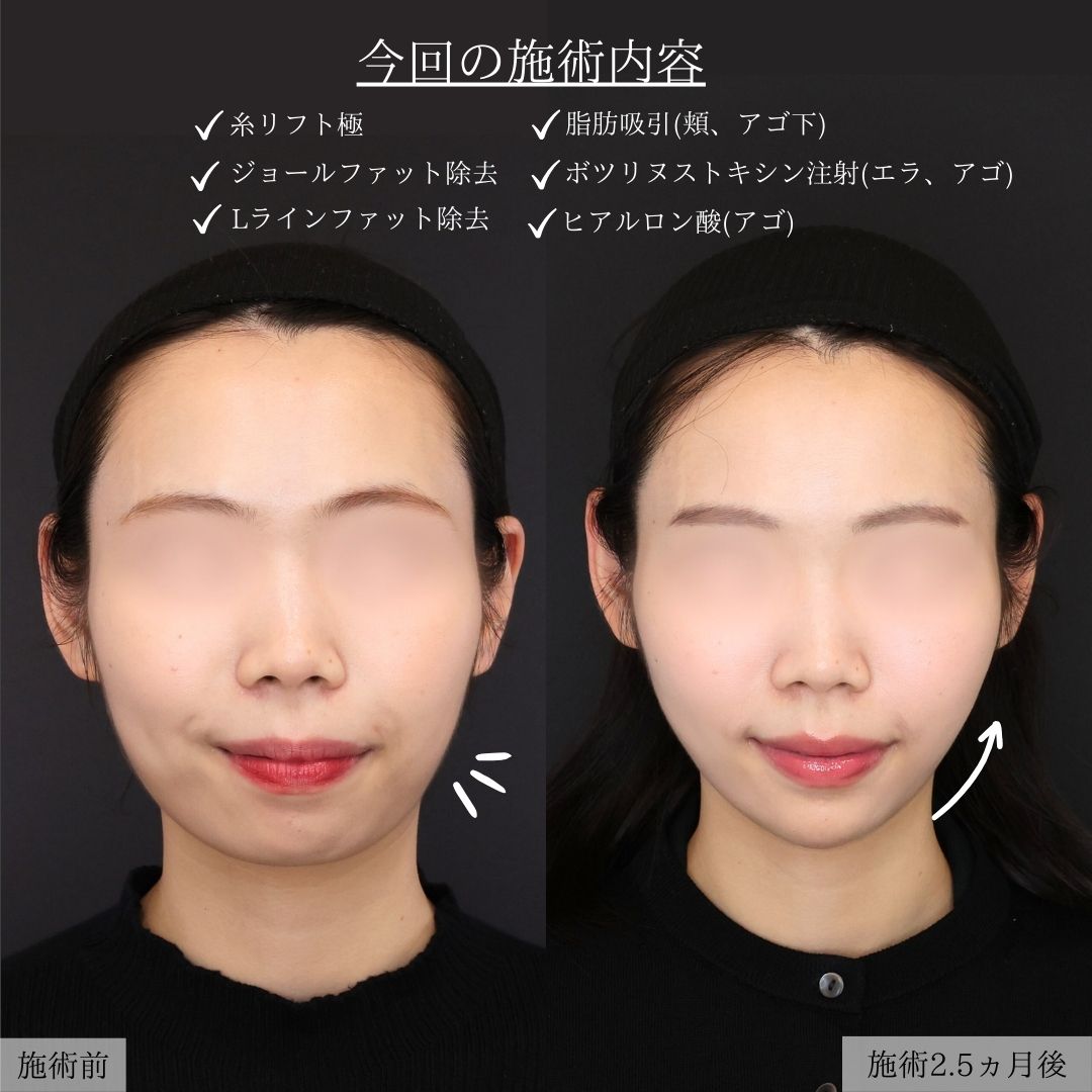 エラボトックス注射/顔の脂肪吸引/ジョールファット除去の症例写真 施術前後