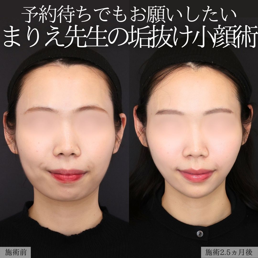 エラボトックス注射/顎下の脂肪吸引/ジョールファット除去の症例写真 施術前後 