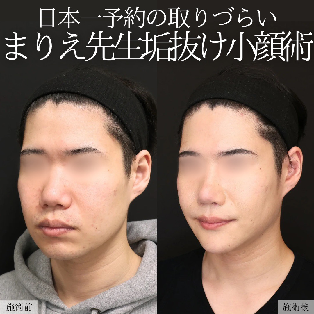 TAC式 ツヤ肌コラーゲンリフト®/小顔整形｜パーフェクトフェイスライン/バッカルファット除去の症例写真 施術前後 