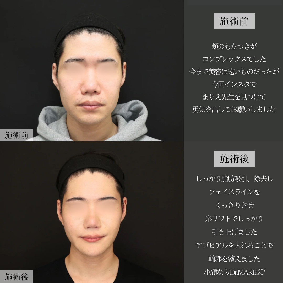 TAC式 ツヤ肌コラーゲンリフト®/小顔整形｜パーフェクトフェイスライン/バッカルファット除去の症例写真 施術前後 