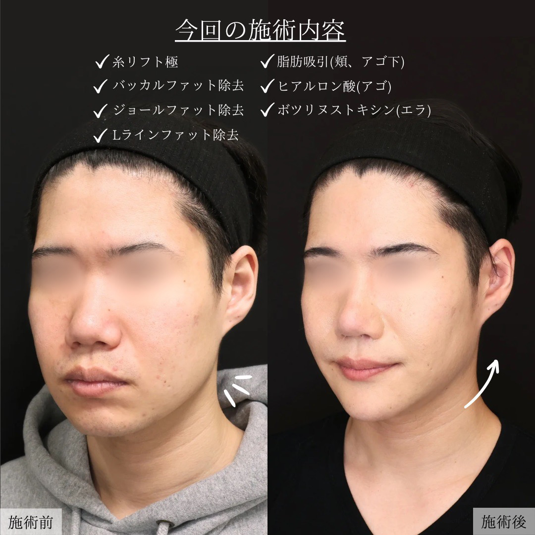 TAC式 ツヤ肌コラーゲンリフト®/小顔整形｜パーフェクトフェイスライン/バッカルファット除去の症例写真 施術前後 