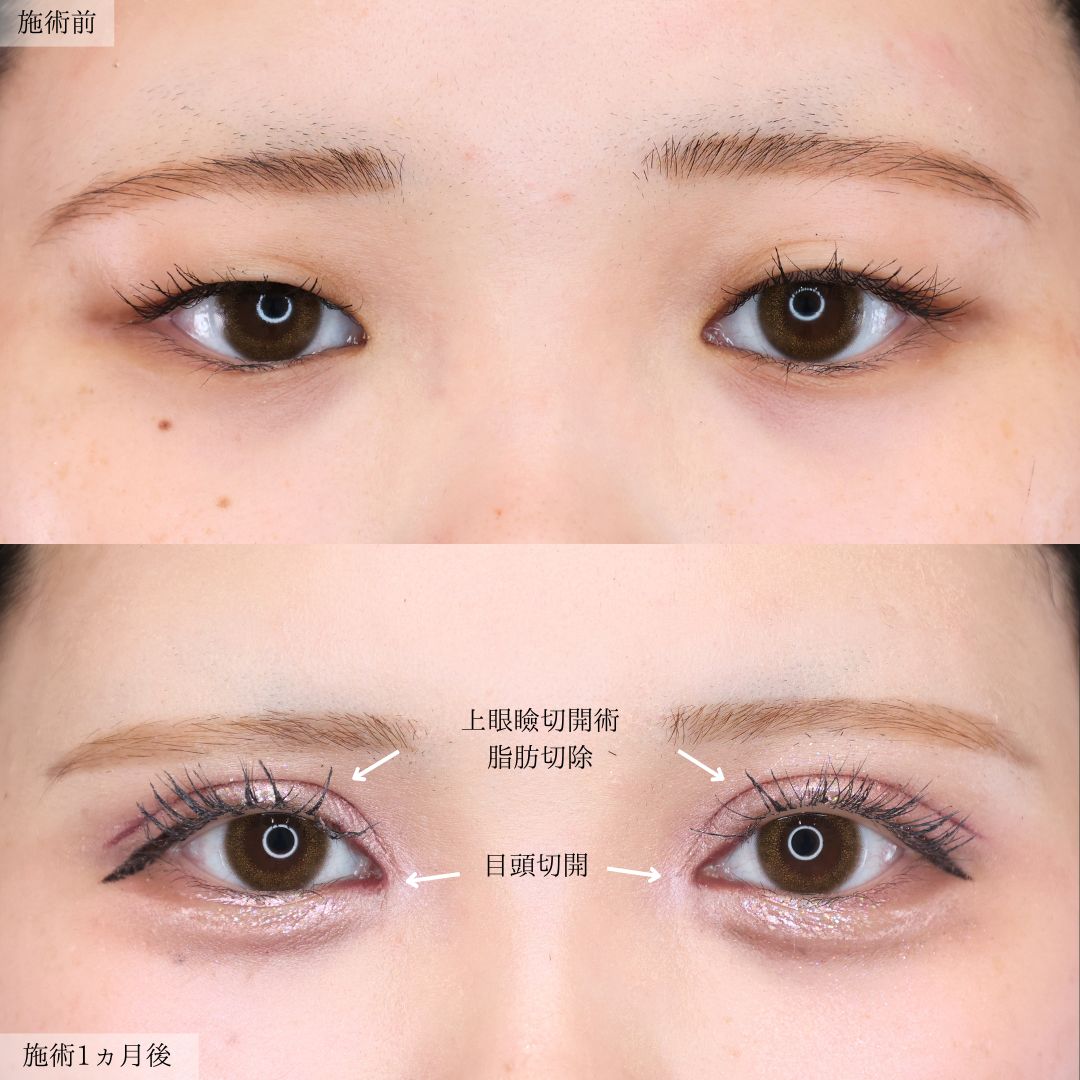 上眼瞼切開術/目頭切開術の症例写真 施術前後 