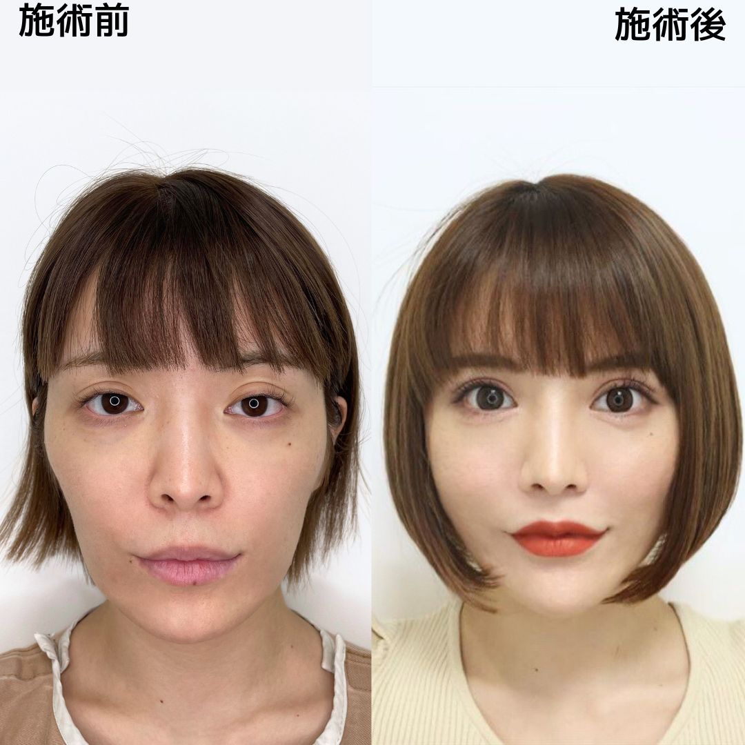 【妹尾ユウカ様】《糸リフトで小顔》可愛さの秘訣はメンテナンスの糸リフト♡