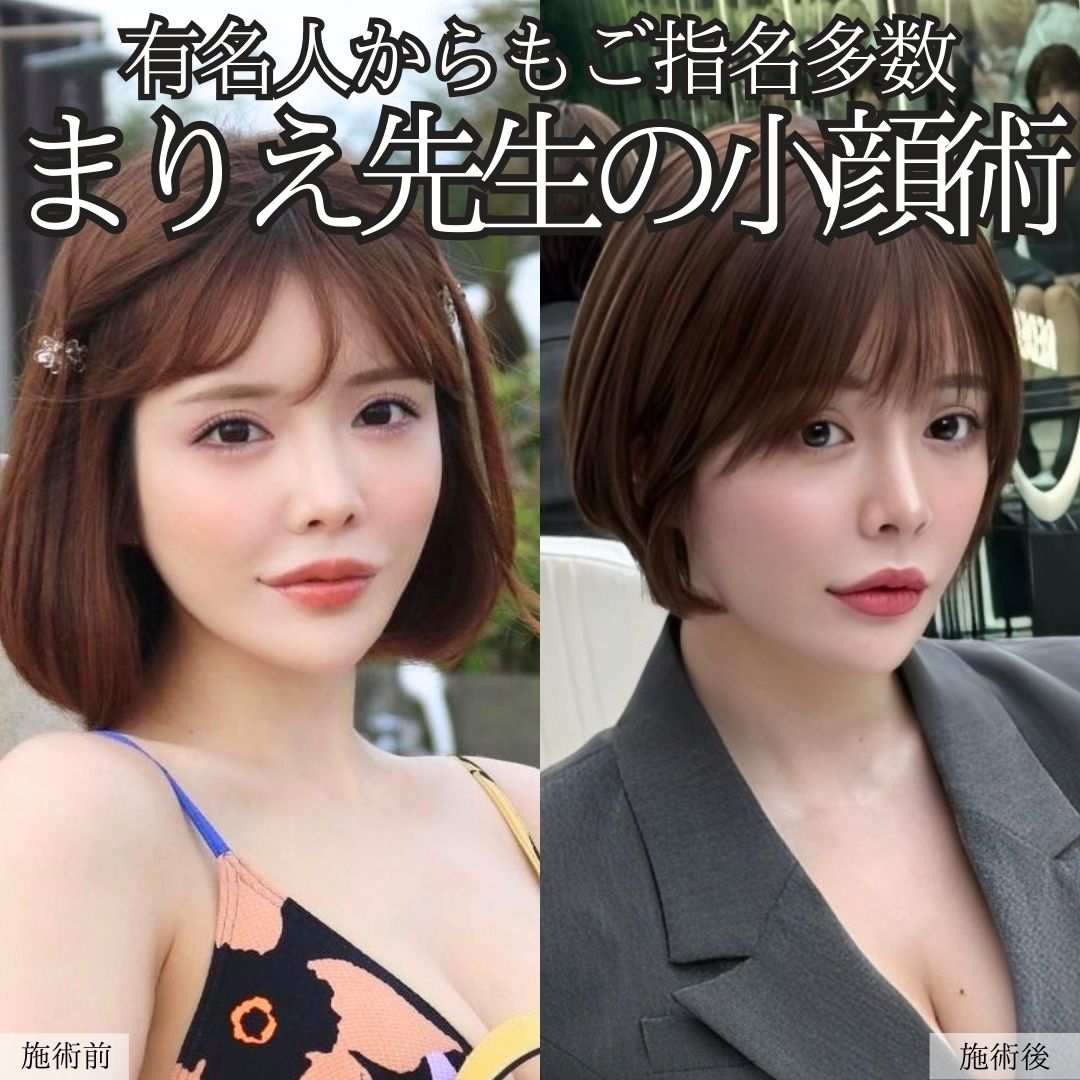 TAC式 ツヤ肌コラーゲンリフト®/ほうれい線のヒアルロン酸注射/顎のヒアルロン酸注射の症例写真 施術前後 