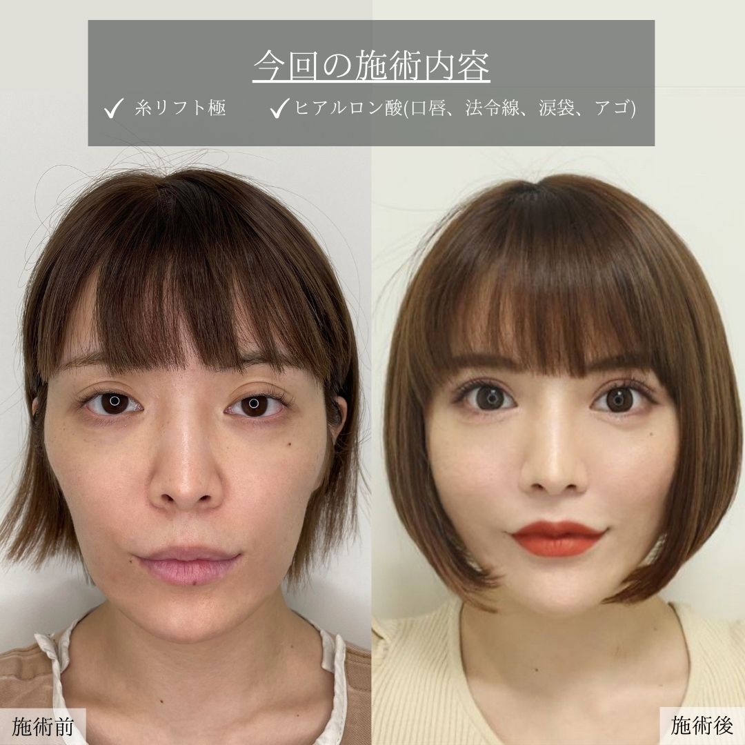 TAC式 ツヤ肌コラーゲンリフト®/ほうれい線のヒアルロン酸注射/顎のヒアルロン酸注射の症例写真 施術前後 