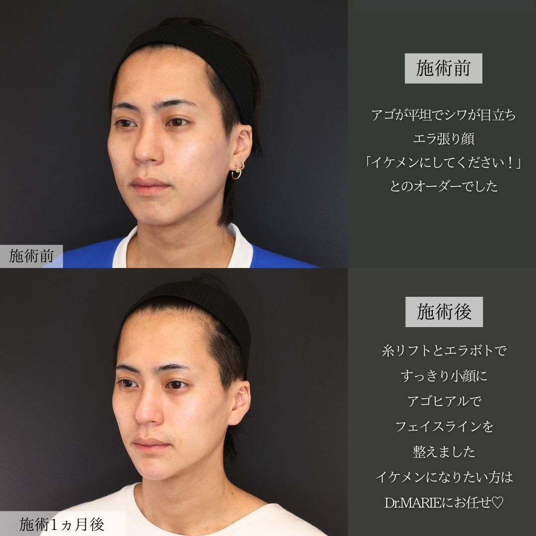 エラボトックス注射/TAC式 ツヤ肌コラーゲンリフト®/顎のヒアルロン酸注射の症例写真 施術前後 