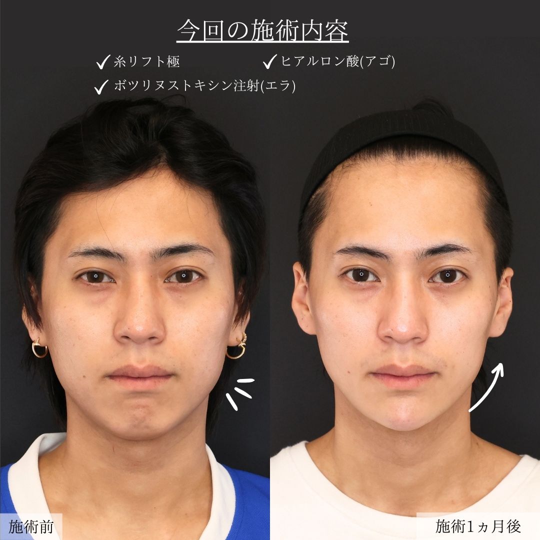 エラボトックス注射/TAC式 ツヤ肌コラーゲンリフト®/顎のヒアルロン酸注射の症例写真 施術前後 